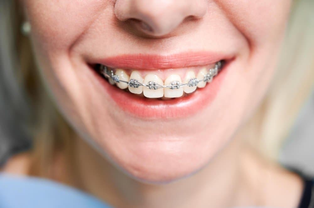 Orthodontic Braces